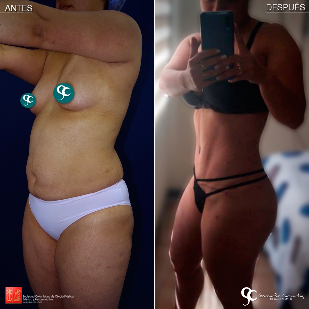 Antes y después de abdominoplastia en Bogotá